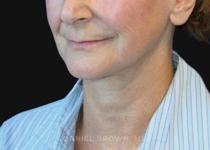 Neck Restoration Before & After Patient #10531