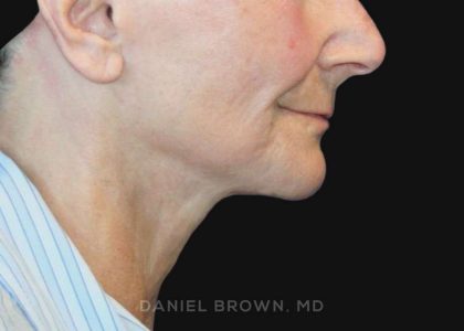 Neck Restoration Before & After Patient #10531