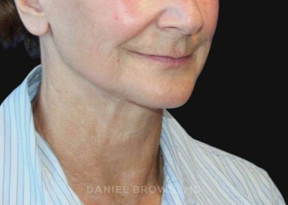 Neck Restoration Before & After Patient #10531