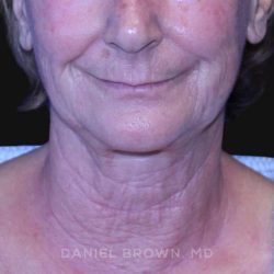 Neck Restoration Before & After Patient #10531