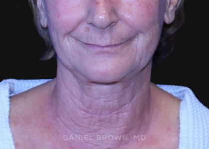 Neck Restoration Before & After Patient #10531