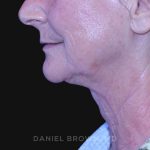 Neck Restoration Before & After Patient #10531