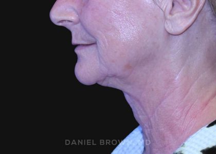 Neck Restoration Before & After Patient #10531