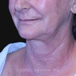 Neck Restoration Before & After Patient #10531