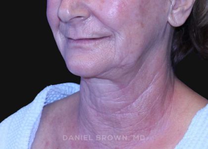 Neck Restoration Before & After Patient #10531