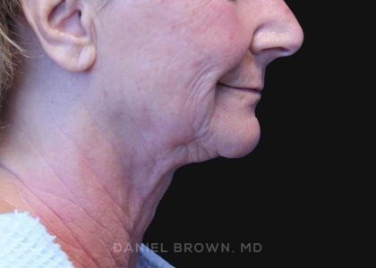 Neck Restoration Before & After Patient #10531