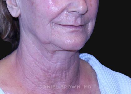 Neck Restoration Before & After Patient #10531