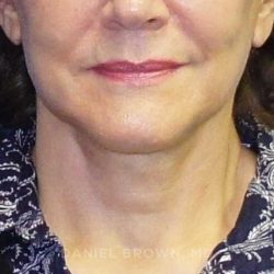 Neck Restoration Before & After Patient #10542