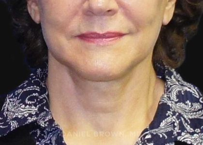 Neck Restoration Before & After Patient #10542