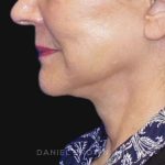 Neck Restoration Before & After Patient #10542