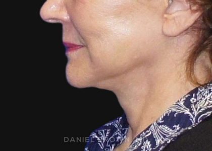 Neck Restoration Before & After Patient #10542