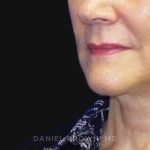 Neck Restoration Before & After Patient #10542