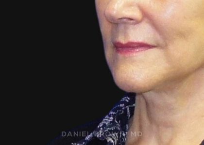 Neck Restoration Before & After Patient #10542