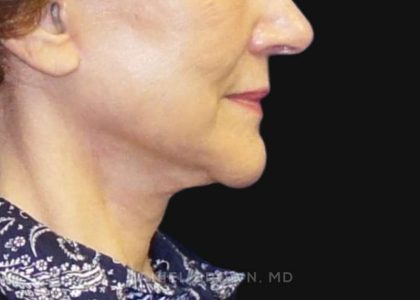 Neck Restoration Before & After Patient #10542