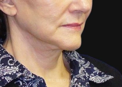 Neck Restoration Before & After Patient #10542