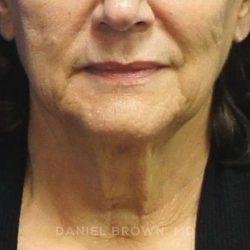 Neck Restoration Before & After Patient #10542