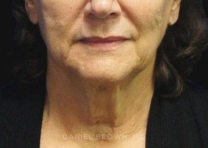 Neck Restoration Before & After Patient #10542