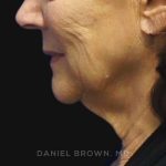 Neck Restoration Before & After Patient #10542