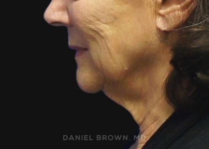 Neck Restoration Before & After Patient #10542
