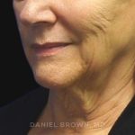 Neck Restoration Before & After Patient #10542