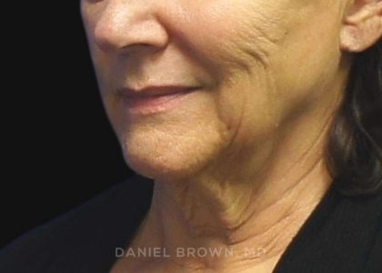 Neck Restoration Before & After Patient #10542