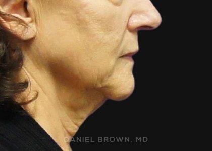 Neck Restoration Before & After Patient #10542