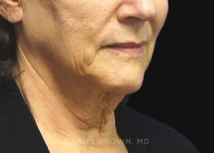 Neck Restoration Before & After Patient #10542