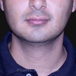 Neck Restoration Before & After Patient #10553