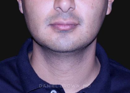 Neck Restoration Before & After Patient #10553