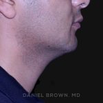 Neck Restoration Before & After Patient #10553