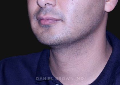 Neck Restoration Before & After Patient #10553