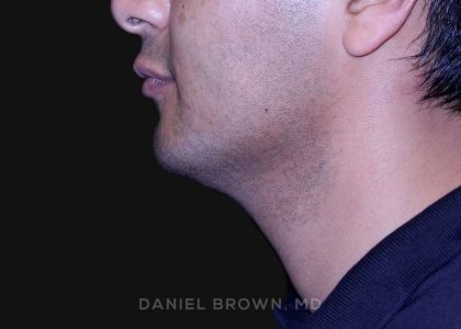 Neck Restoration Before & After Patient #10553