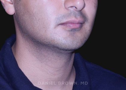 Neck Restoration Before & After Patient #10553