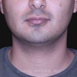 Neck Restoration Before & After Patient #10553