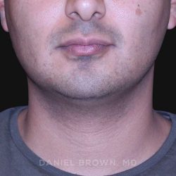 Neck Restoration Before & After Patient #10553