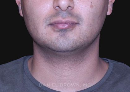 Neck Restoration Before & After Patient #10553