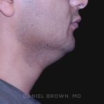 Neck Restoration Before & After Patient #10553