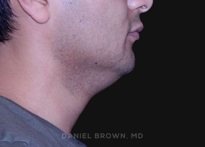 Neck Restoration Before & After Patient #10553