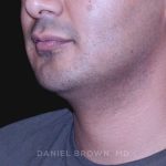 Neck Restoration Before & After Patient #10553