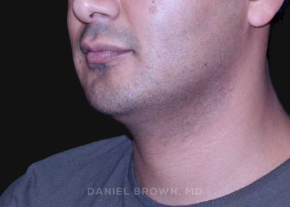Neck Restoration Before & After Patient #10553