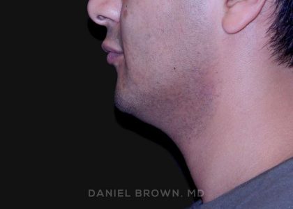 Neck Restoration Before & After Patient #10553