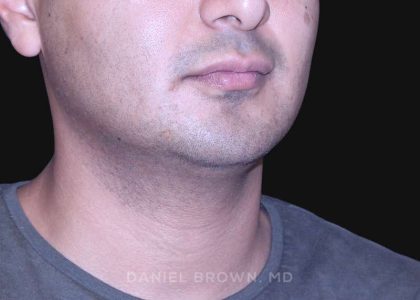Neck Restoration Before & After Patient #10553