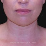 Neck Restoration Before & After Patient #10562