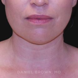 Neck Restoration Before & After Patient #10562