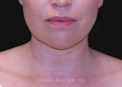 Neck Restoration Before & After Patient #10562