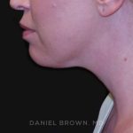 Neck Restoration Before & After Patient #10562