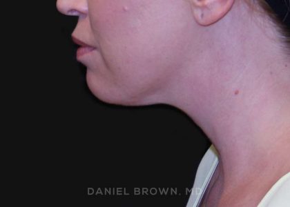 Neck Restoration Before & After Patient #10562
