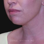 Neck Restoration Before & After Patient #10562