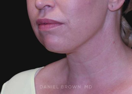 Neck Restoration Before & After Patient #10562