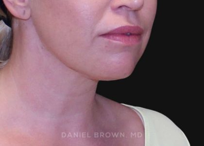 Neck Restoration Before & After Patient #10562